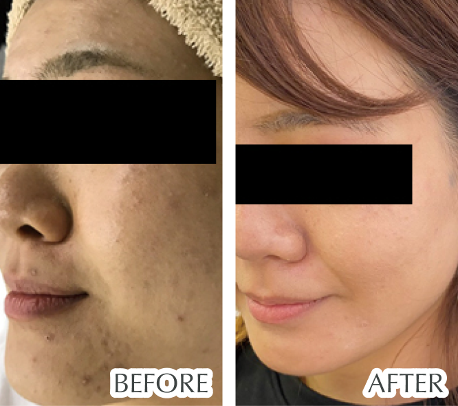 ニキビ、ニキビ跡、くすみ