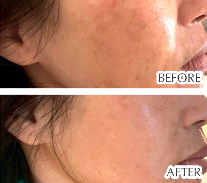 シミ・肝斑・たるみ