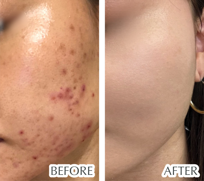 炎症ニキビ、ニキビ跡、色素沈着