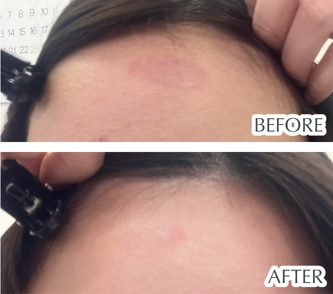 やけど跡、ニキビ