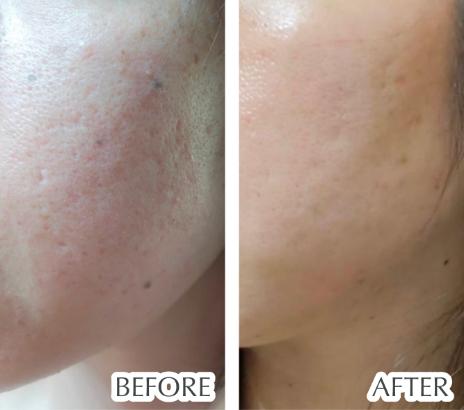 毛穴、クレーター、ニキビ跡